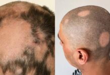 पंजाब में गंजेपन का इलाज बना मुसीबत: दवा लगाते ही मची अफरा-तफरी ! जाने सारी जानकारी