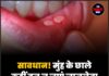 सावधान! मुंह के छाले कहीं बन न जाएं जानलेवा बीमारी का संकेत