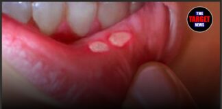 सावधान! मुंह के छाले कहीं बन न जाएं जानलेवा बीमारी का संकेत
